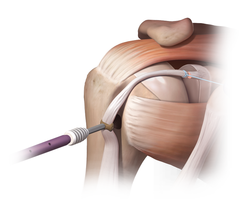 Arinko Arthrex - SwiveLock® Tenodesis Technique